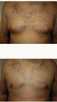 38 Year Old Man Treated With Male Breast Reduction With Doctor Thomas C. Wiener, MD, Houston Plastic Surgeon