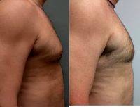38 Year Old Man Who Underwent Liposuction For Male Breast Reduction (gynecomastia) With Dr Elan B. Singer