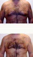 38 Year Old Man With Male Breast Reduction By Dr Cynthia L. Mizgala, MD, Metairie Plastic Surgeon