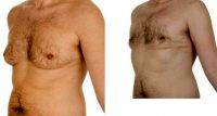 39 Year Old Male Treated For Gynaecomastia With Dr Jonathan J. Staiano, FRCS (Plast), Birmingham Plastic Surgeon