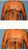 40 Year Old Man Treated With Male Breast Reduction With Dr Jennifer Weintraub, MD, Palo Alto Plastic Surgeon
