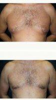 40 Year Old Man Treated With Male Breast Reduction With Dr. Semira Bayati, MD, FACS, Orange County Plastic Surgeon