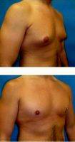 41 Year Old Man Treated With Male Breast Reduction By Dr Jason E. Leedy, MD, Cleveland Plastic Surgeon