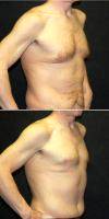 41 Year Old Man Treated With Male Breast Reduction By Dr Jeffrey D. Wagner, MD, Indianapolis Plastic Surgeon