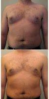 42 Year Old Man Treated With Male Breast Reduction With Doctor Don W. Griffin, MD, Nashville Plastic Surgeon