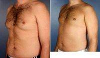 43 Year Old Liposuction, Male Breast Reduction With Dr. Christa Clark, MD, FACS, Sacramento Plastic Surgeon
