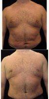 43 Year Old Man Treated With Male Breast Reduction With Doctor Don W. Griffin, MD, Nashville Plastic Surgeon
