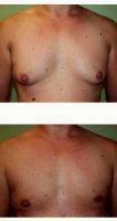 44 Year Old Man Treated With Male Breast Reduction By Doctor Earl Stephenson, Jr., MD, DDS, FACS, Atlanta Plastic Surgeon