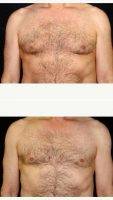 45-54 Year Old Man Treated With Male Breast Reduction By Doctor Andrew M. Lofman, MD, FACS, Detroit Plastic Surgeon