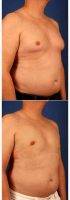 45-54 Year Old Man Treated With Male Breast Reduction By Dr. Carlos Mata, MD, MBA, FACS, Scottsdale Plastic Surgeon