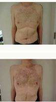 45-54 Year Old Man Treated With Male Breast Reduction By Dr. Richard Zienowicz, MD, Providence Plastic Surgeon