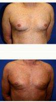 45-54 Year Old Man Treated With Male Breast Reduction By Dr. Zoran Potparic, MD, Fort Lauderdale Plastic Surgeon