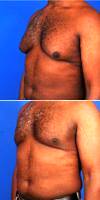 45-54 Year Old Man Treated With Male Breast Reduction - Gynecomastia Treatment With Vaser With Doctor Robert Caridi, MD, Austin Plastic Surgeon