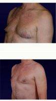 45-54 Year Old Man Treated With Male Breast Reduction With Doctor William H. Gorman, MD, Austin Plastic Surgeon
