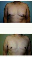 45-54 Year Old Woman Treated With Male Breast Reduction By Dr Leo Lapuerta, MD, Houston Plastic Surgeon