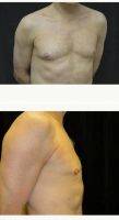 45 Year Old Man Treated With Male Breast Reduction By Doctor Christopher J. Davidson, MD, FACS, Boston Plastic Surgeon