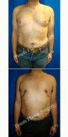 46 Year Old Woman Treated With Male Breast Reduction By Dr. Tom J. Pousti, MD, FACS, San Diego Plastic Surgeon