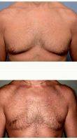 48 Year Old Man Treated With Male Breast Reduction By Dr. Barry L. Eppley, MD, DMD, Indianapolis Plastic Surgeon
