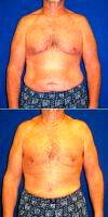 49 Year Old Man Treated With Male Breast Reduction With Dr. Douglas L. Forman, MD, Bethesda Plastic Surgeon