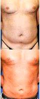 51 Year Old Man Treated With Male Breast Reduction By Dr. Zoran Potparic, MD, Fort Lauderdale Plastic Surgeon