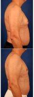 53 Year Old Man Treated With Male Breast Reduction By Doctor Carlos Mata, MD, MBA, FACS, Scottsdale Plastic Surgeon