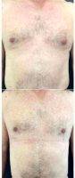53 Year Old Man Treated With Male Breast Reduction With Dr Carolina Restrepo, MD, Colombia Plastic Surgeon