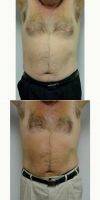 55-64 Year Old Man Treated With Male Breast Reduction By Doctor Jonathan Hall, MD, Boston Plastic Surgeon