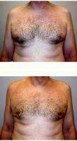 58 Year Old Man Treated With Male Breast Reduction By Doctor Michael Zenn, MD, Durham Plastic Surgeon