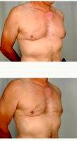 59 Year Old Man Treated With Male Breast Reduction By Dr R. Scott Yarish, MD, Houston Plastic Surgeon