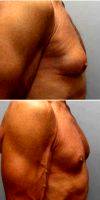 65-74 Year Old Man Treated With Male Breast Reduction With Doctor Robert A. Hardesty, MD, FACS, Riverside Plastic Surgeon