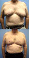70 Year Old Man Treated With Male Breast Reduction By Dr. David E. Berman, MD, Sterling Plastic Surgeon