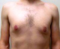 A Male Breast Reduction Is A Procedure That Is Performed For Gynecomastia