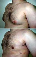 Adult Male Treated For Breast Reduction By Doctor Elliot W. Jacobs, MD, New York Plastic Surgeon