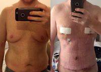 Before After Gynecomastia And Tummy Tuck Scars