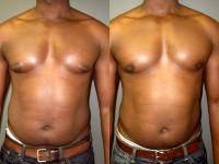 Before And After Enlargement Of The Gland Tissue Of The Male Breast