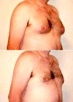 Before And After Gynecomastia Treatment With Liposuction With Dr. Scott E. Kasden, MD, FACS, Dallas Plastic Surgeon