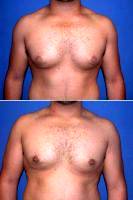 Before And After Male Breast Surgery By Dr Shahram Salemy, MD, FACS, Seattle Plastic Surgeon