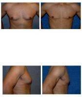 Correction Of Gynecomastia (Male Breast Reduction), 42 Year Old Male, 5' 167 Lbs With Dr. Samuel N. Pearl, MD, San Jose Plastic Surgeon