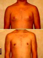 Correction Of Gynecomastia With Doctor David B. Reath, MD, Knoxville Plastic Surgeon