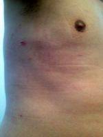 Crater Deformity Be Fixed After Gynecomastia