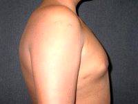 Doctor Andres Taleisnik, MD, Orange County Plastic Surgeon 16 Year Old Male Underwent Male Breast Reduction Surgery