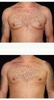 Doctor Andrew M. Lofman, MD, FACS, Detroit Plastic Surgeon 25-34 Year Old Man Treated With Male Breast Reduction