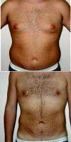 Doctor Andrew P. Amunategui, MD, Miami Plastic Surgeon 34 Year Old Man Treated With Male Breast Reduction