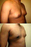 Doctor Arnold S. Breitbart, MD, FACS, Long Island Plastic Surgeon 25 Year Old Male Treated For Gynecomastia