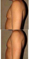 Doctor Babak Dadvand, MD, Los Angeles Plastic Surgeon 31 Year Old Man Treated With Male Breast Reduction