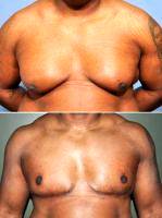 Doctor Barry L. Eppley, MD, DMD, Indianapolis Plastic Surgeon 50 Year Old Male Treated For Severe Gynecomastia