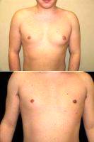 Doctor Benjamin Lam, DO, FACOS, FACS, Philadelphia Plastic Surgeon - 21 Y.o. Male With Excessive Male Breast Tissue