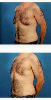 Doctor Brian Coan, MD, FACS, Raleigh-Durham Plastic Surgeon 32 Year Old Man Treated With Male Breast Reduction