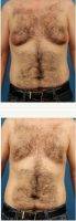 Doctor Brian Coan, MD, FACS, Raleigh-Durham Plastic Surgeon - 32 Year Old Man Treated With Male Breast Reduction Before After