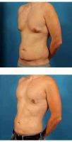 Doctor Brian Coan, MD, FACS, Raleigh-Durham Plastic Surgeon 35 Year Old Man Treated With Male Breast Reduction - Liposuction